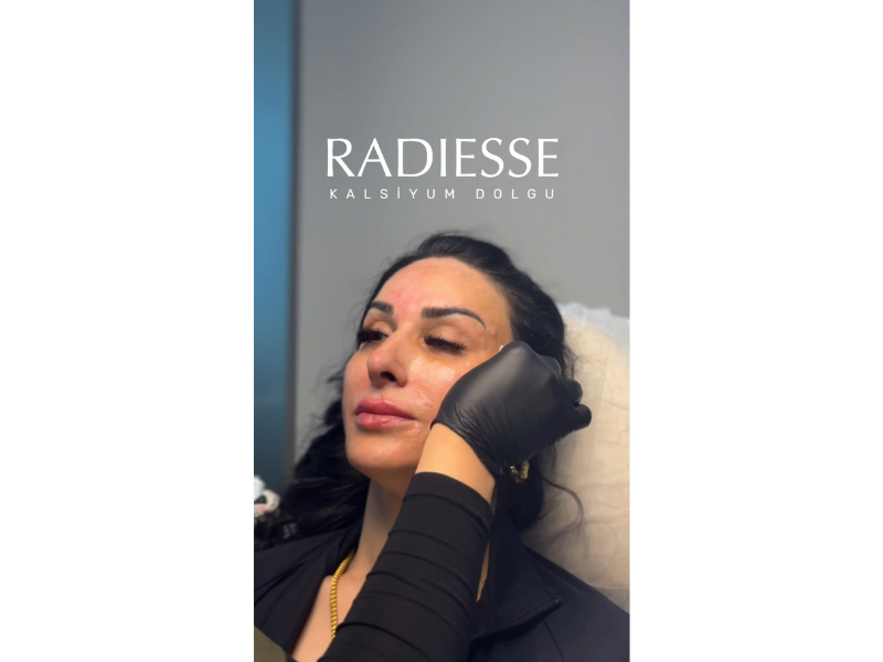 radiesse