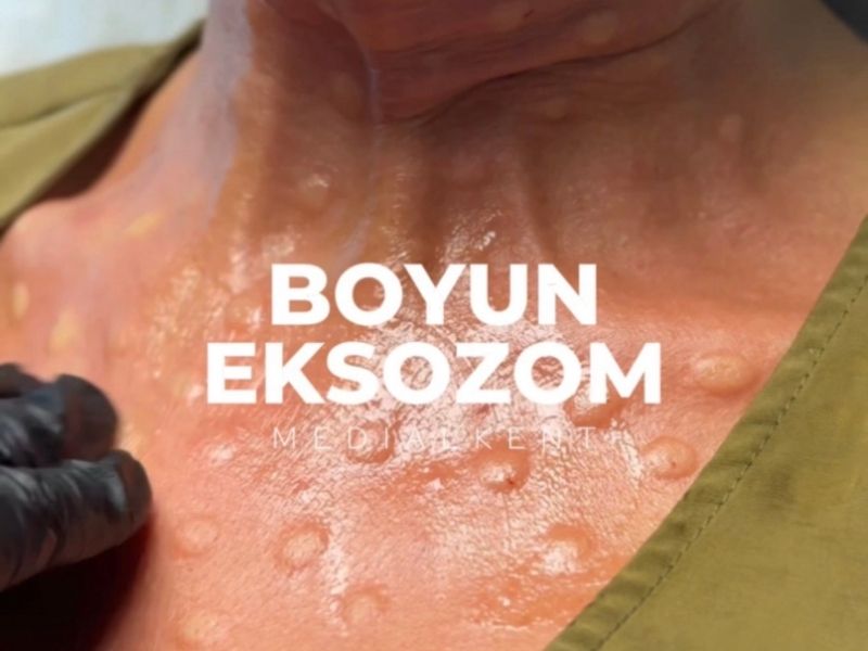 eksozom
